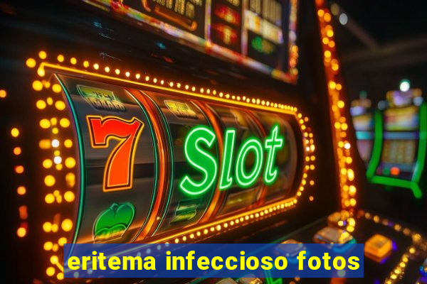 eritema infeccioso fotos