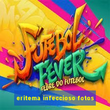 eritema infeccioso fotos